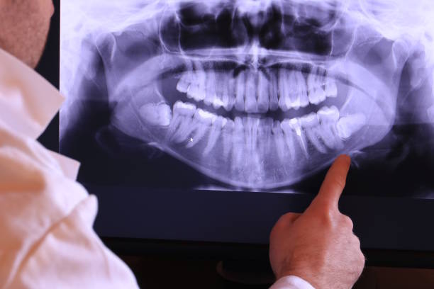 Best Knocked-Out Tooth (Avulsed Tooth) Treatment in Beaumont, CA